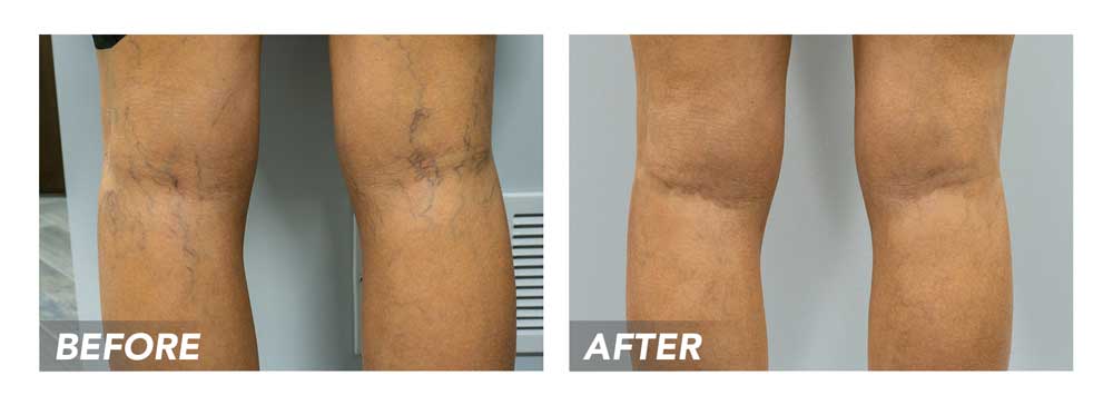Spider Vein Clinic in TX Describes Spider Vein Treatments