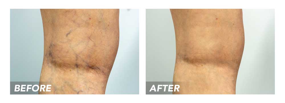 Vein Doctor Describes Spider Vein Treatment in River Oaks