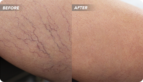 Varicose Vein Center in Texas Discusses Spider Veins and Varicose Veins