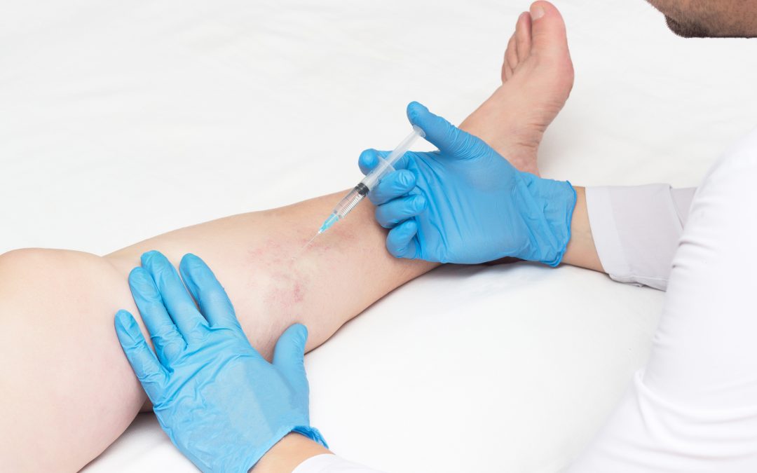 What’s the Best Plan for Vein Therapy in Houston?