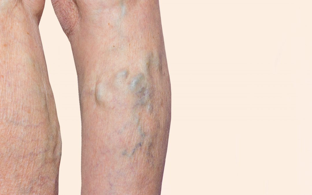 An Overview of Vein Therapy Near River Oaks, Texas