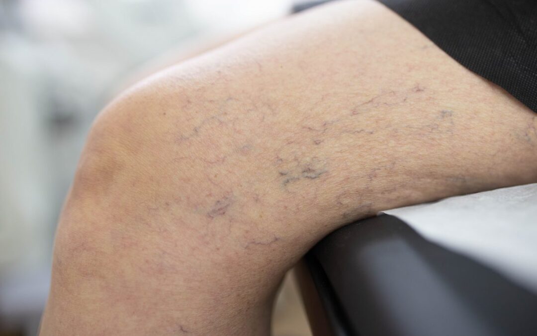Intro to Sclerotherapy in TX
