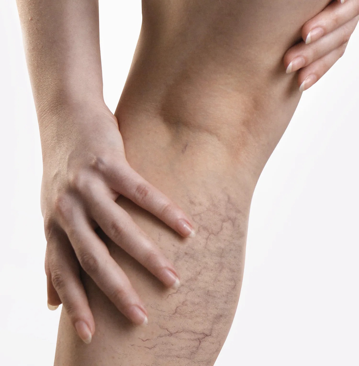 vipcenters_SpidersVeinsmobile_treatment_img1 vipcenters_SpidersVeinsmobile_treatment_img1